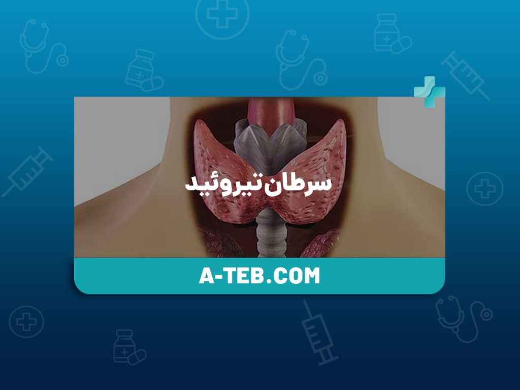 سرطان تیروئید