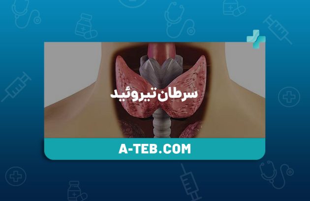 سرطان تیروئید