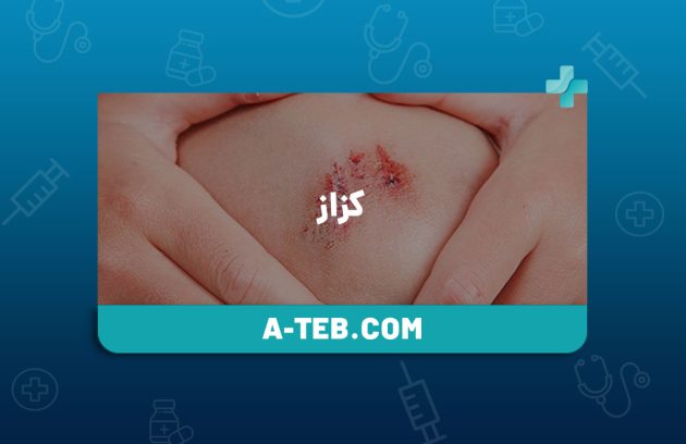 کزاز