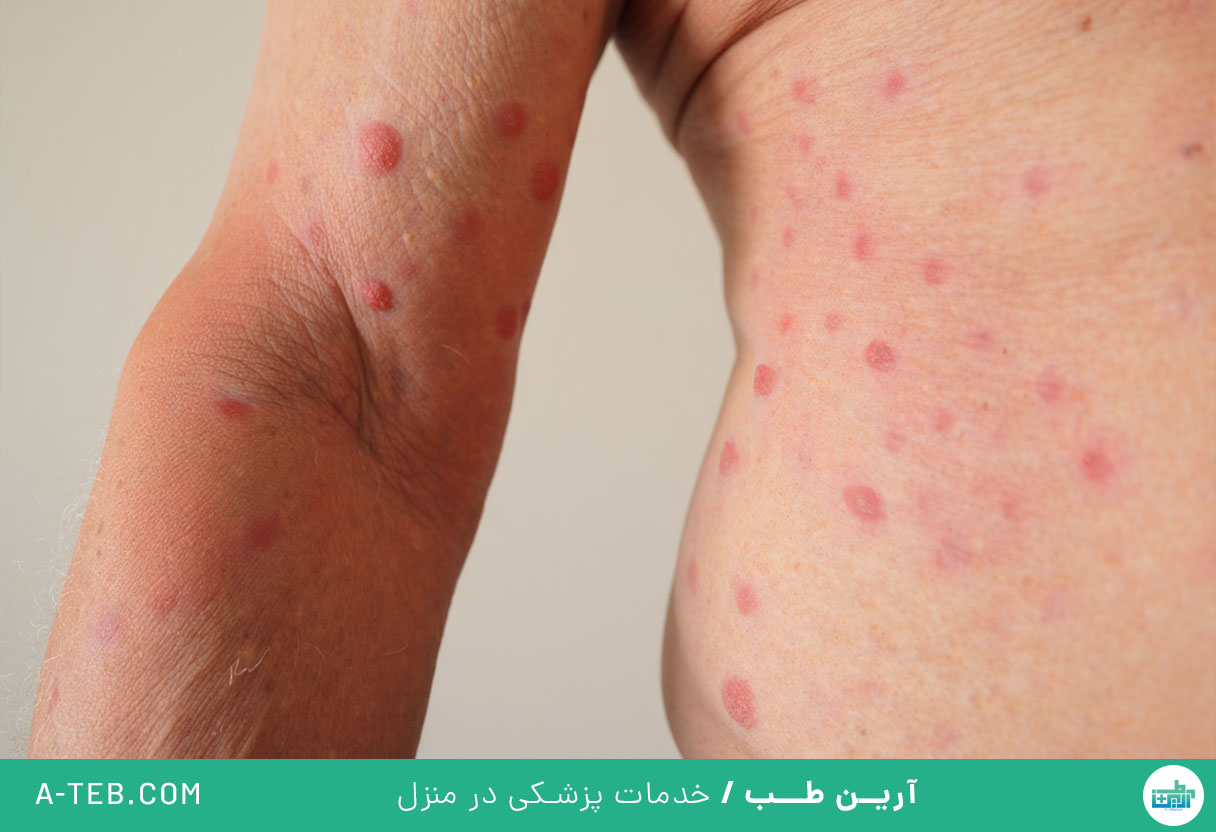شوک آنافیلاکسی