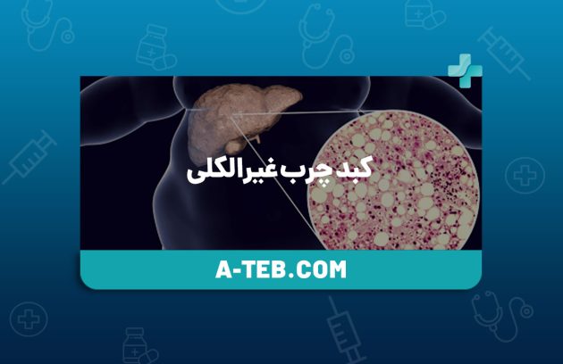 کبد چرب غیرالکلی