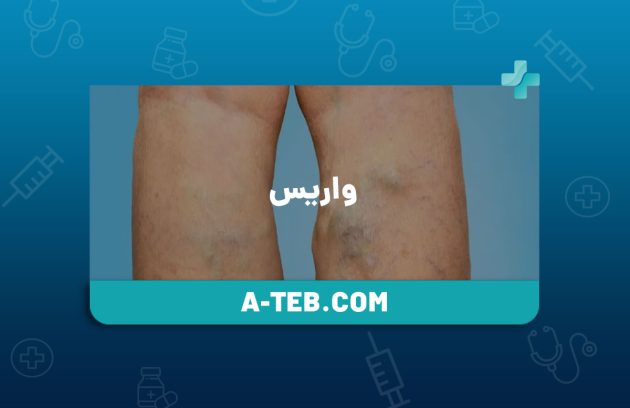 واریس