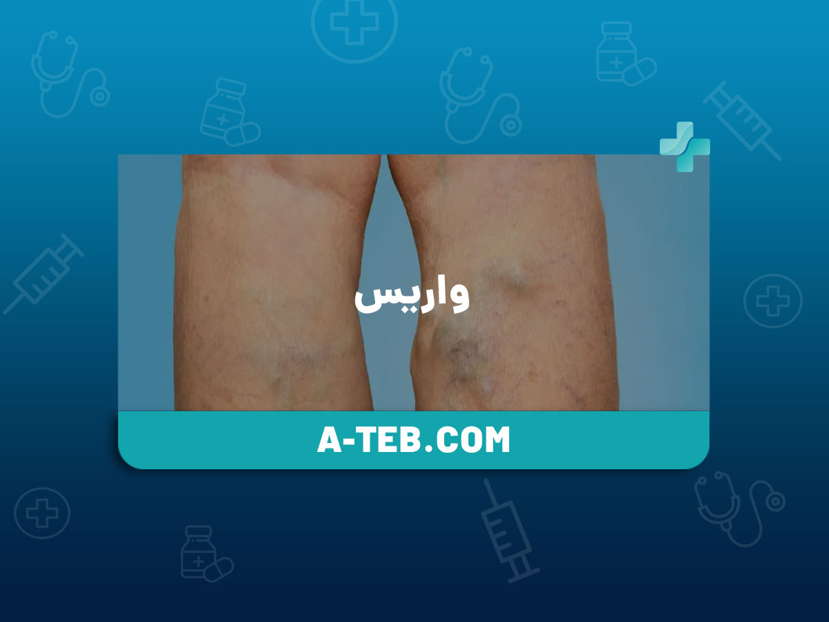 واریس