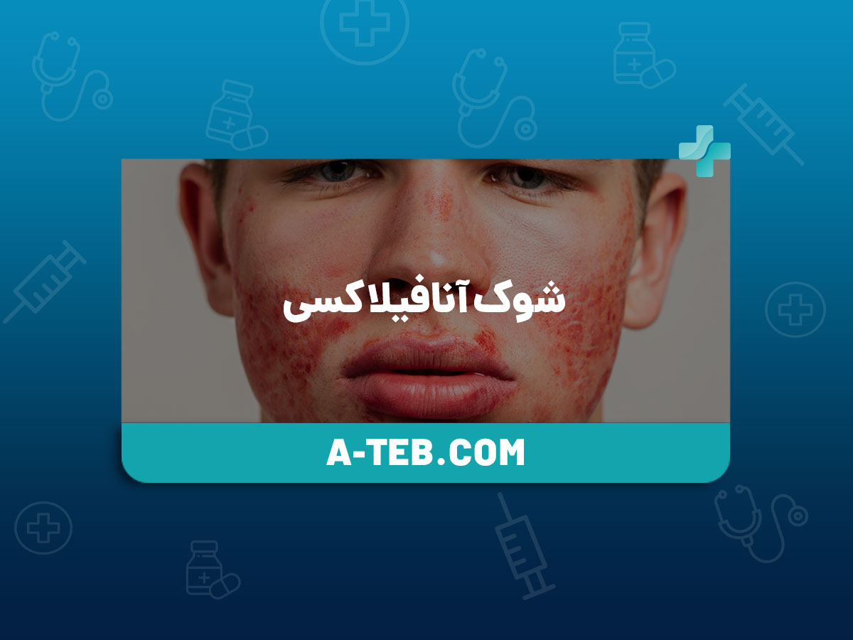 شوک آنافیلاکسی