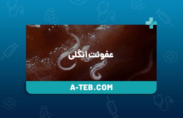 عفونت انگلی