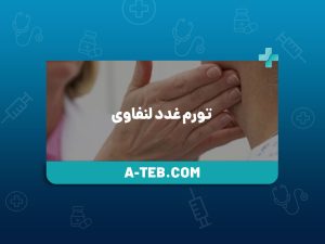 تورم غدد لنفاوی