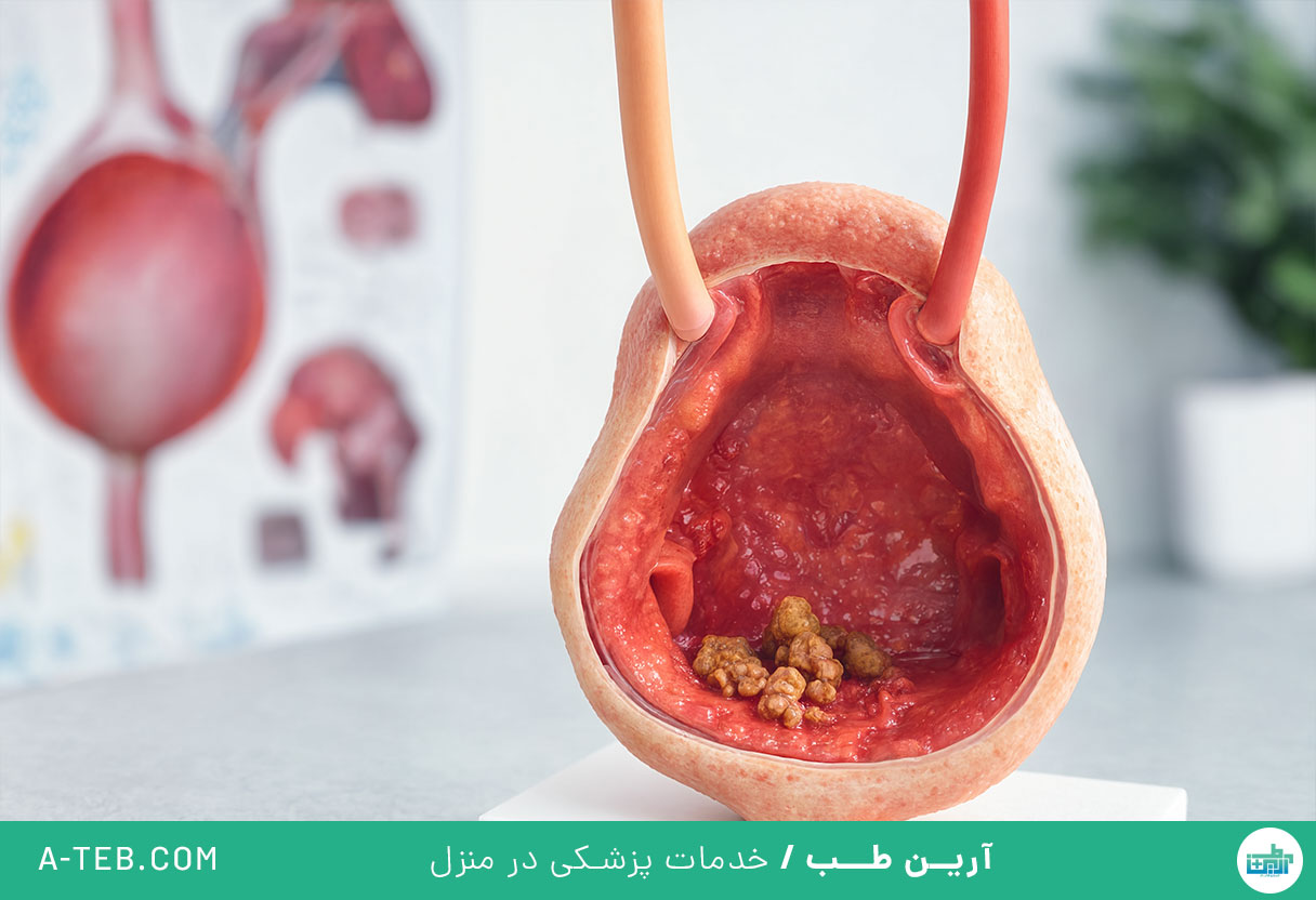 سنگ مثانه