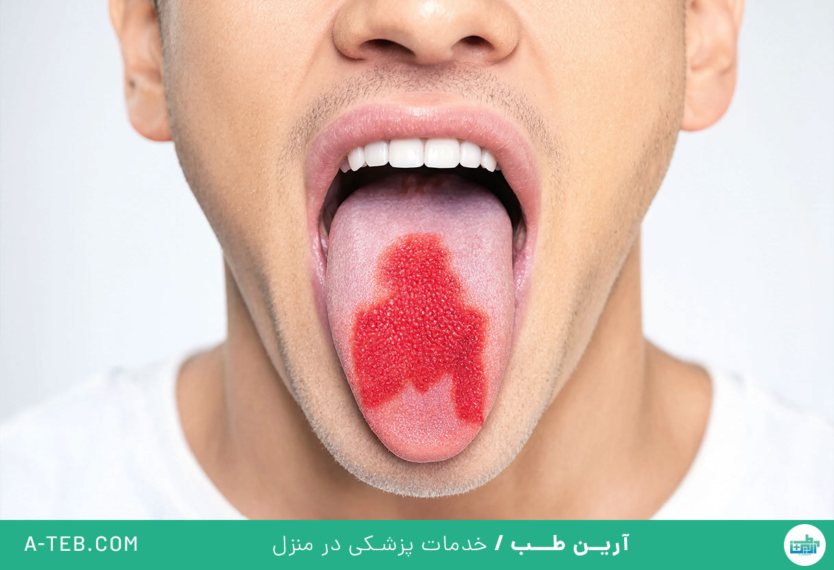 التهاب زبان