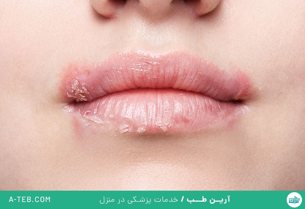 التهاب لب