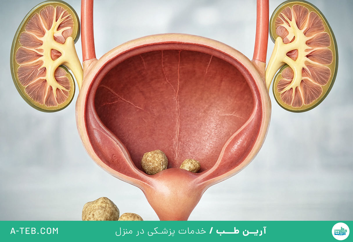 سنگ مثانه
