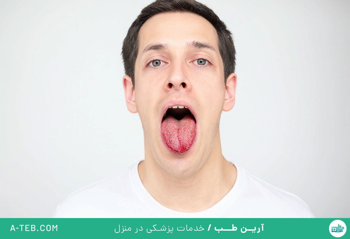 التهاب زبان