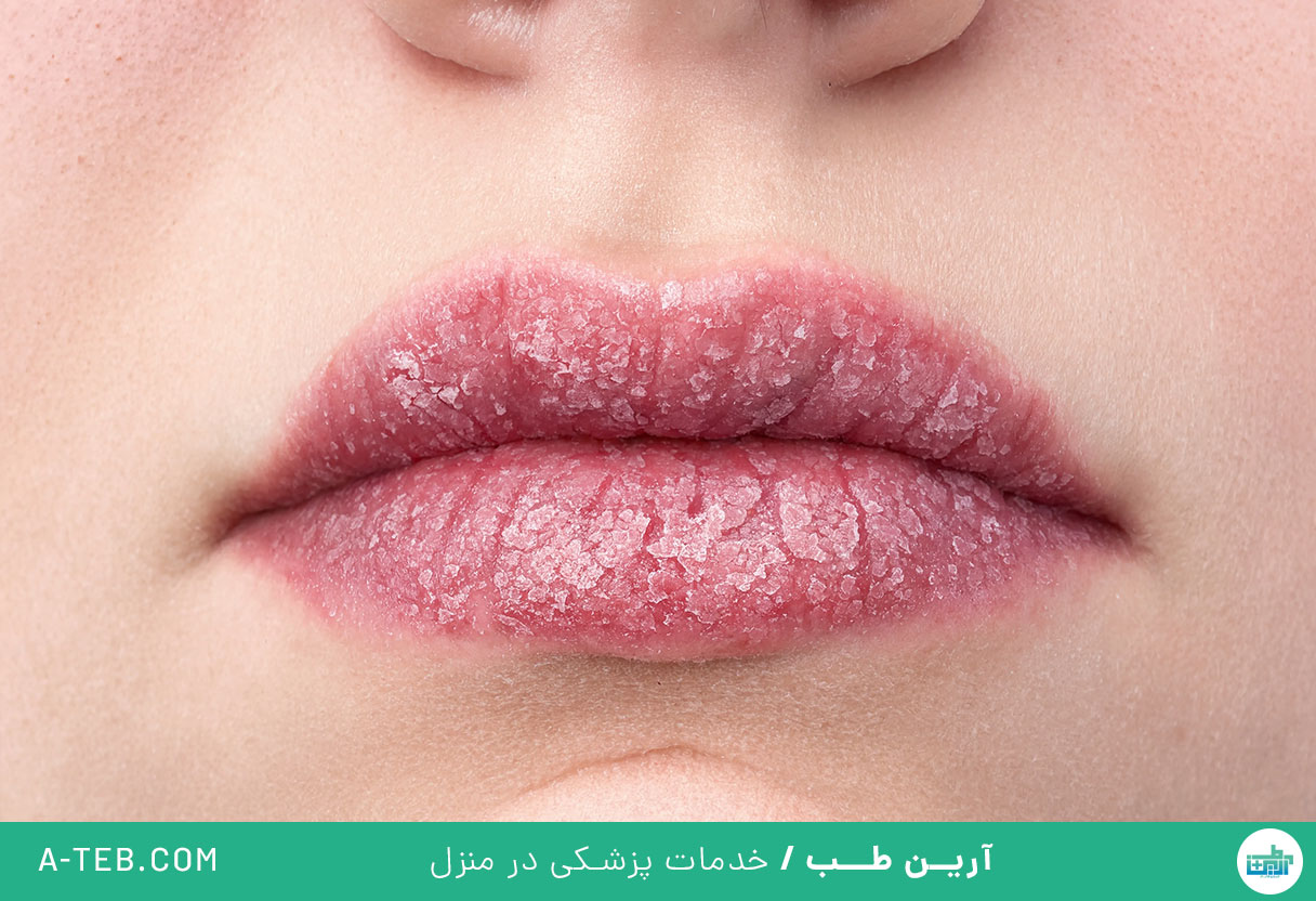 التهاب لب