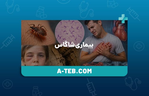 بیماری شاگاس