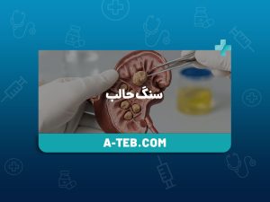 سنگ حالب