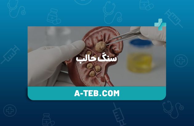 سنگ حالب