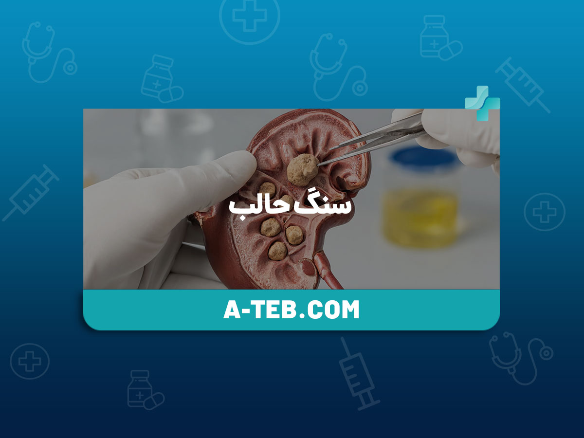 سنگ حالب