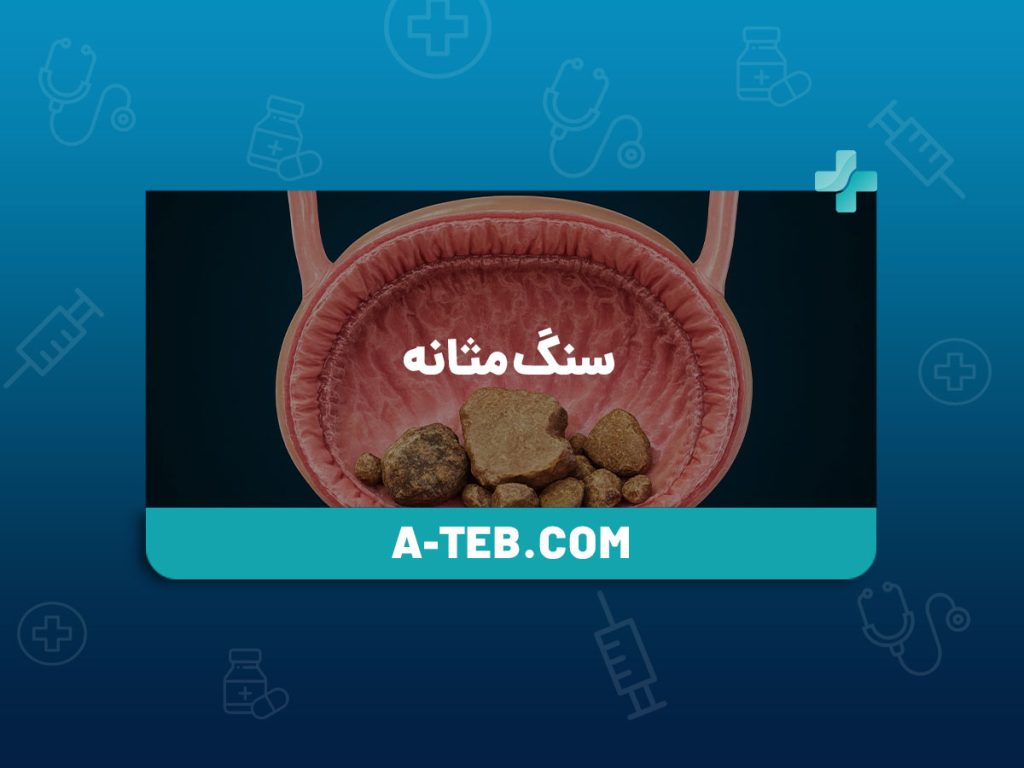 سنگ مثانه