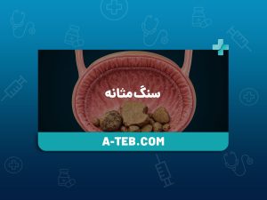 سنگ مثانه
