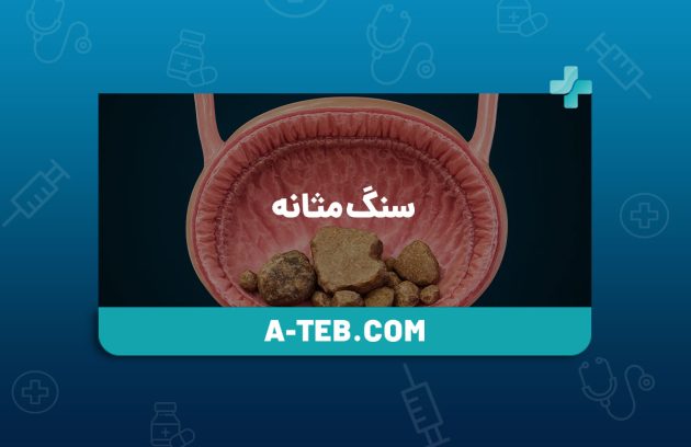 سنگ مثانه