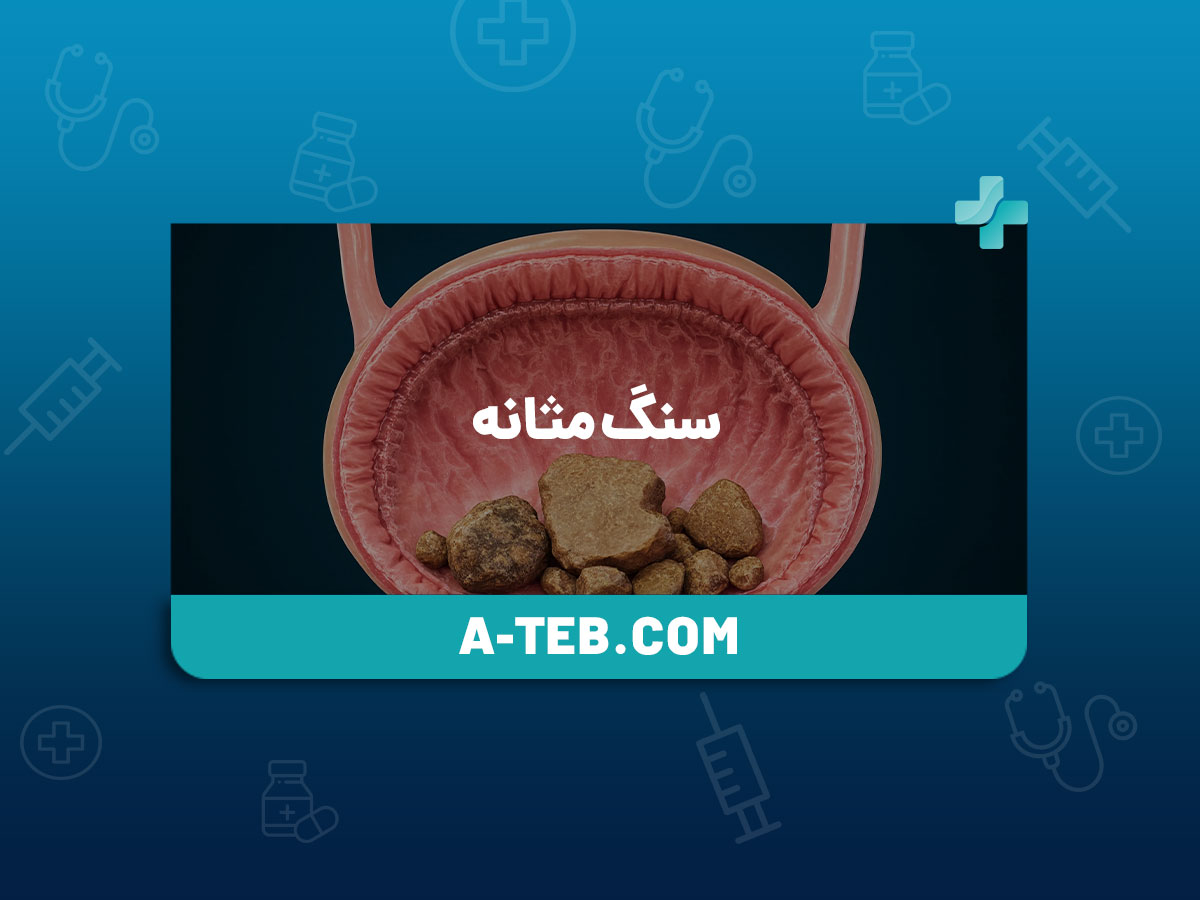 سنگ مثانه