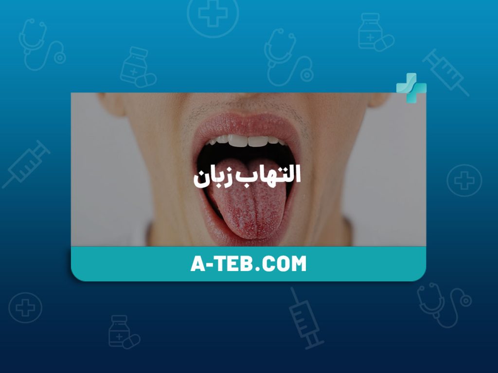 التهاب زبان