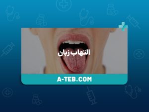التهاب زبان