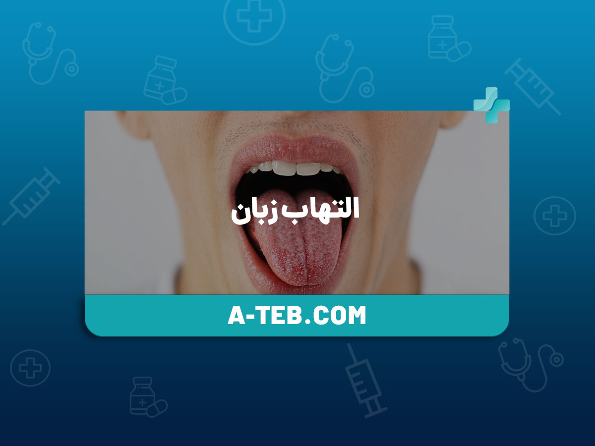 التهاب زبان