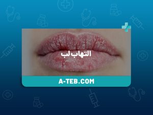 التهاب لب