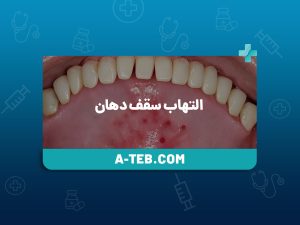 التهاب سقف دهان