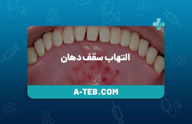 التهاب سقف دهان