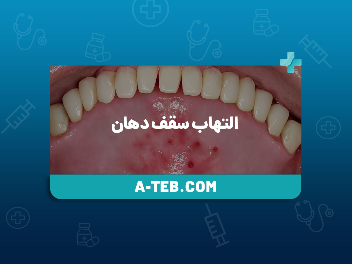 التهاب سقف دهان