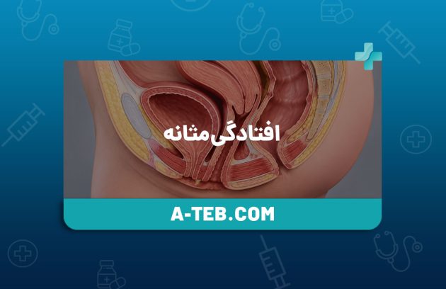 افتادگی مثانه