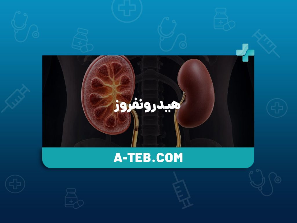 هیدرونفروز