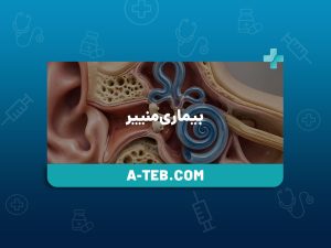 بیماری منییر