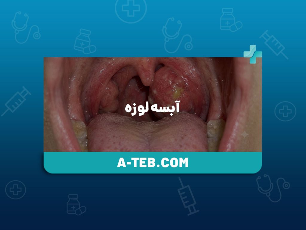 آبسه لوزه