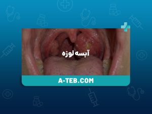 آبسه لوزه
