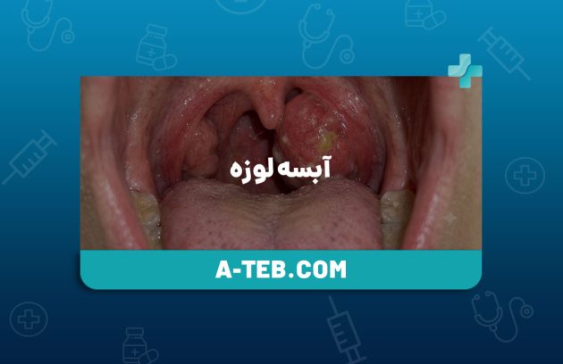 آبسه لوزه