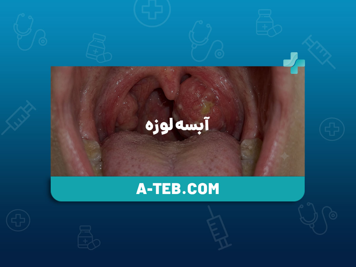 آبسه لوزه