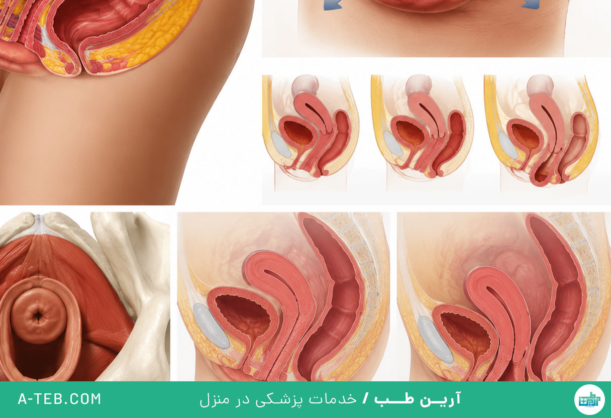 افتادگی مثانه