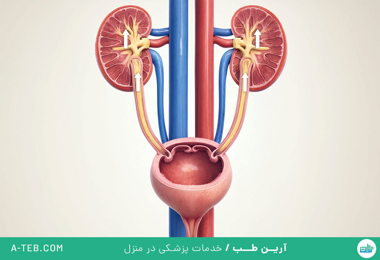 ریفلاکس ادراری