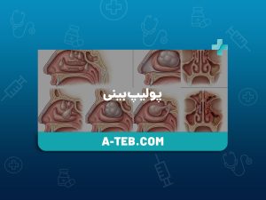 پولیپ بینی