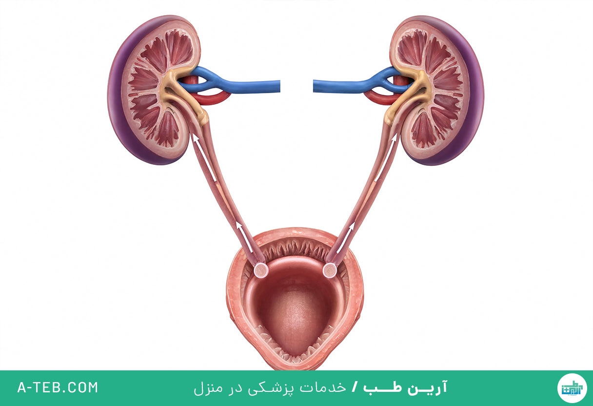 ریفلاکس ادراری