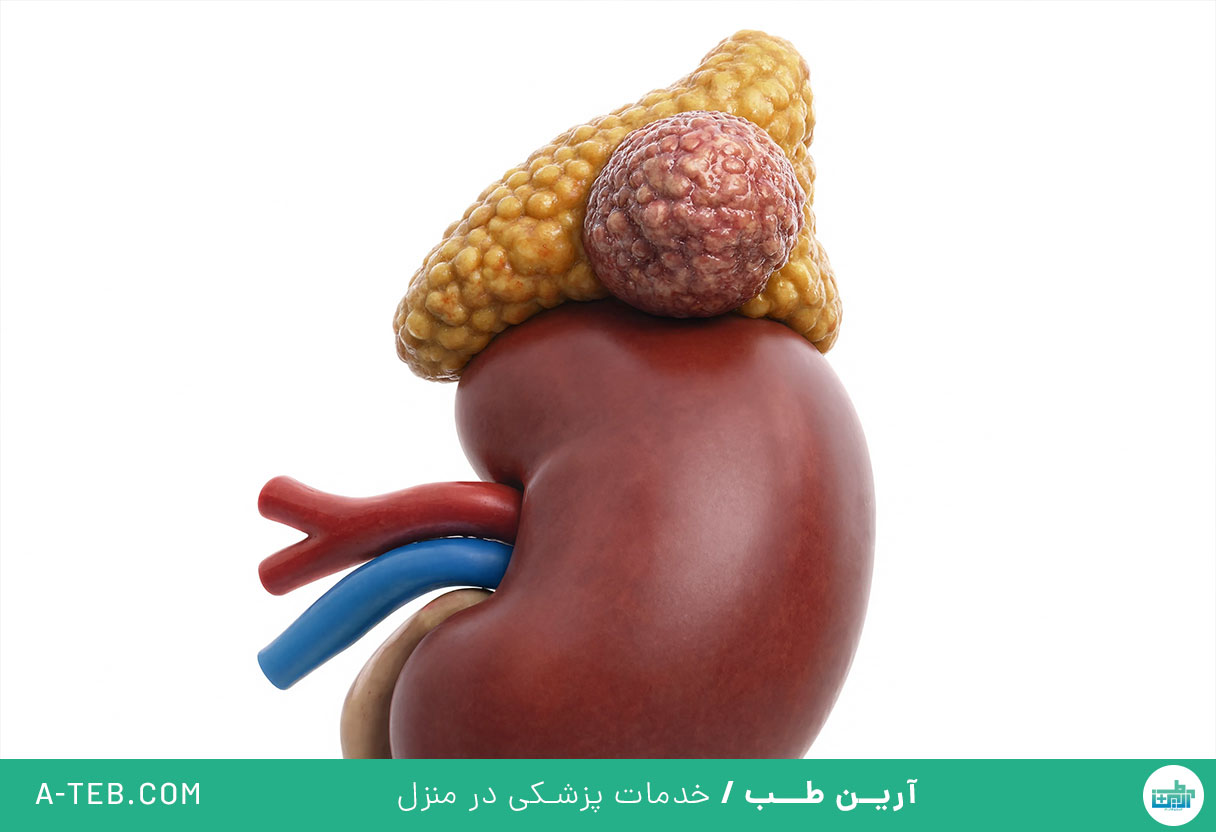 فئوکروموسیتوما