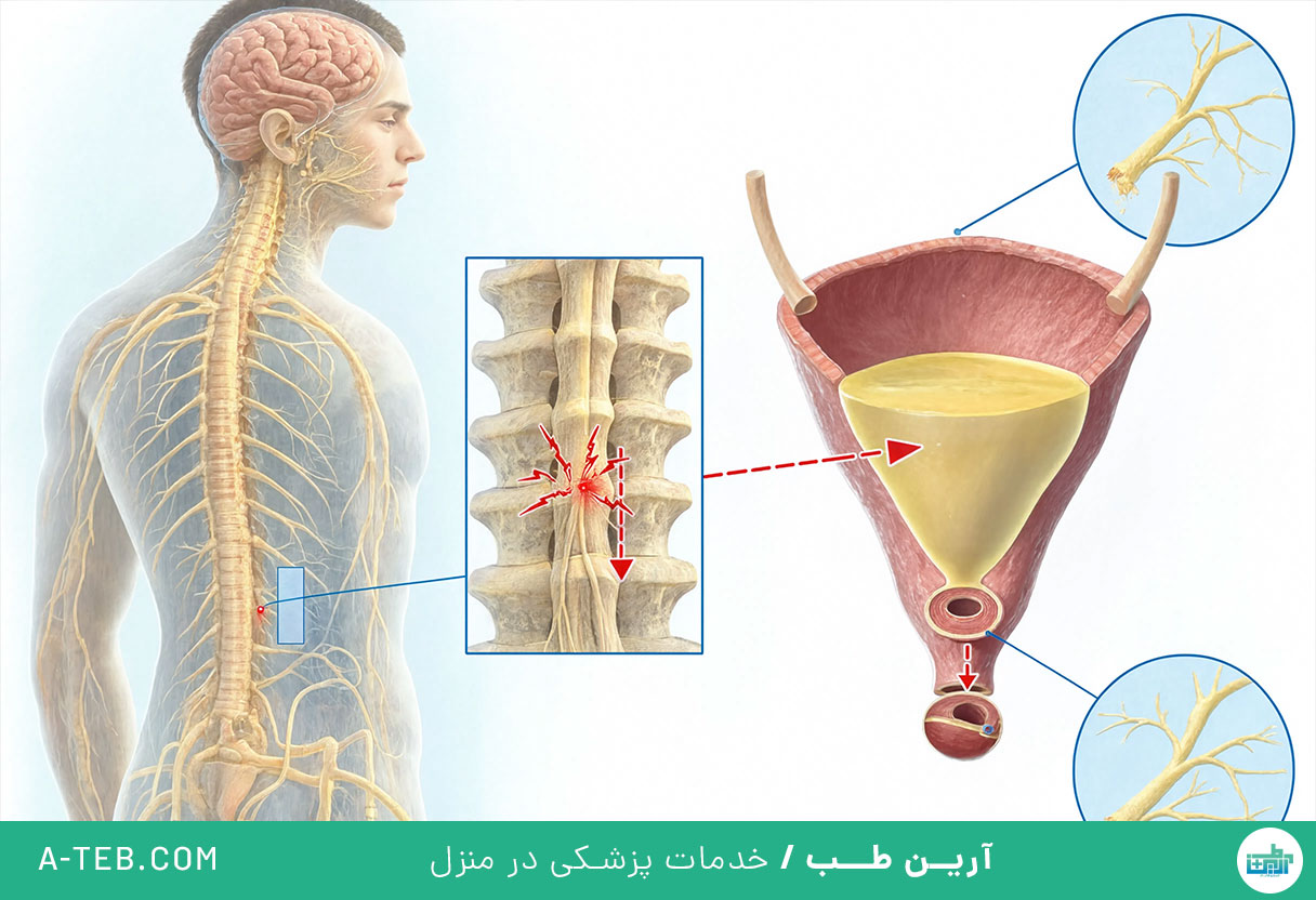 مثانه نوروژنیک