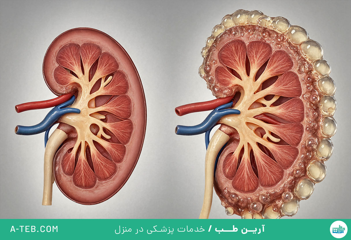 هیدرونفروز