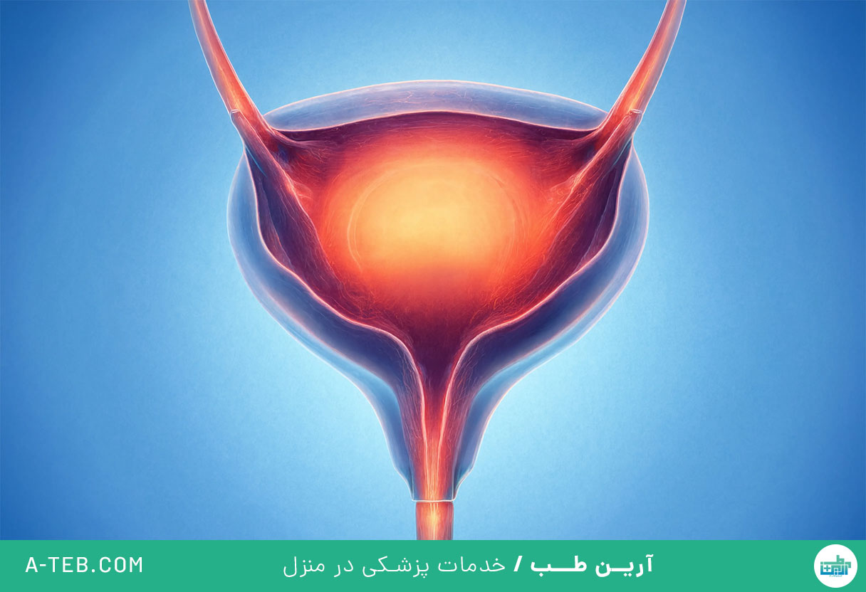مثانه بیش فعال