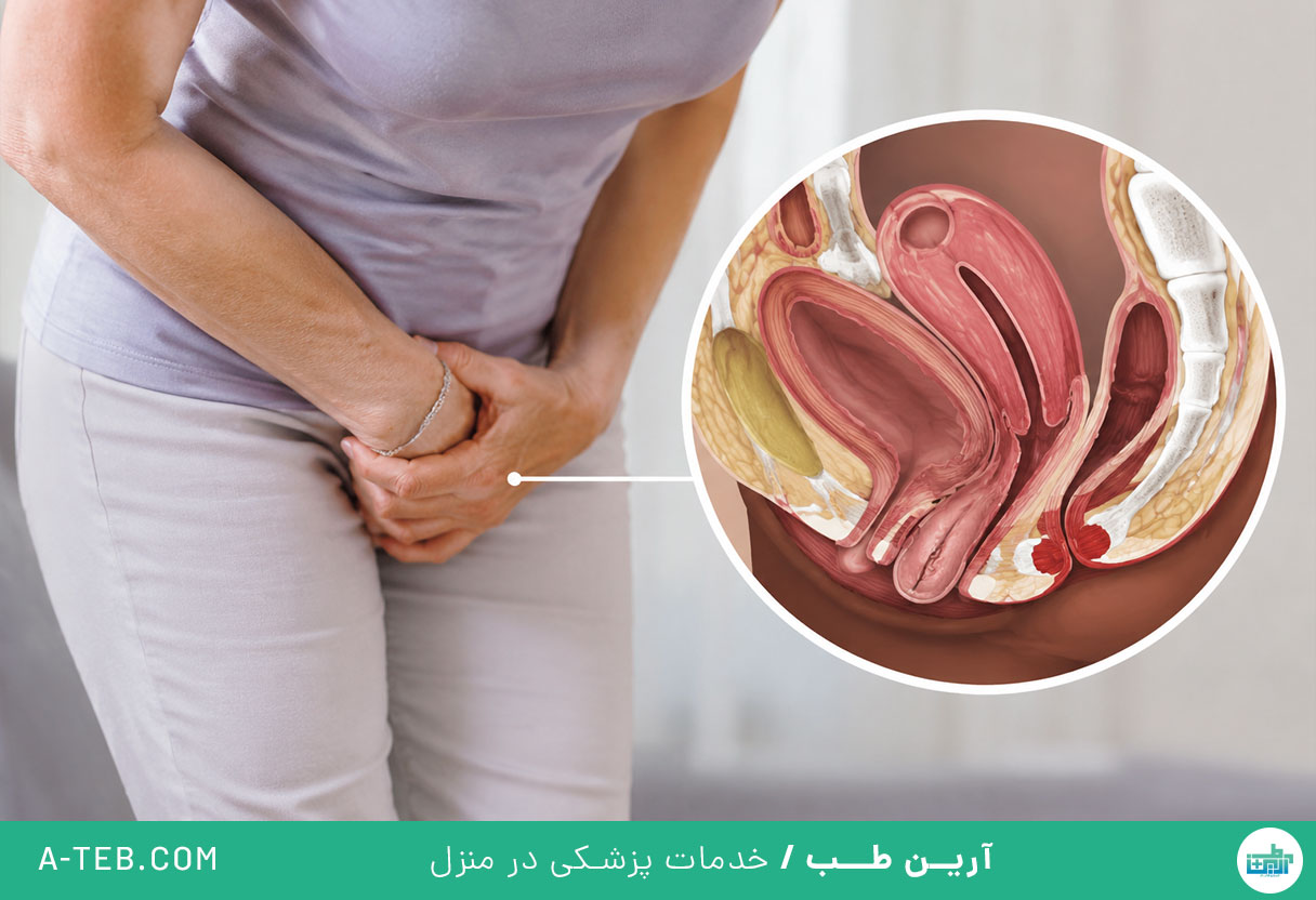 افتادگی مثانه