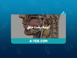 آبسه پشت حلق