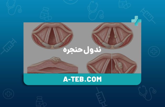 ندول حنجره