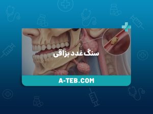 سنگ غدد بزاقی